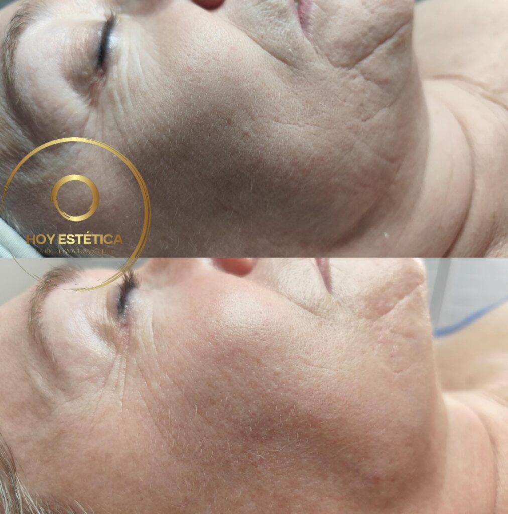 tratamiento facial en pamplona