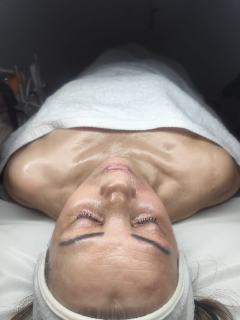 tratameinto exosomas pamplona