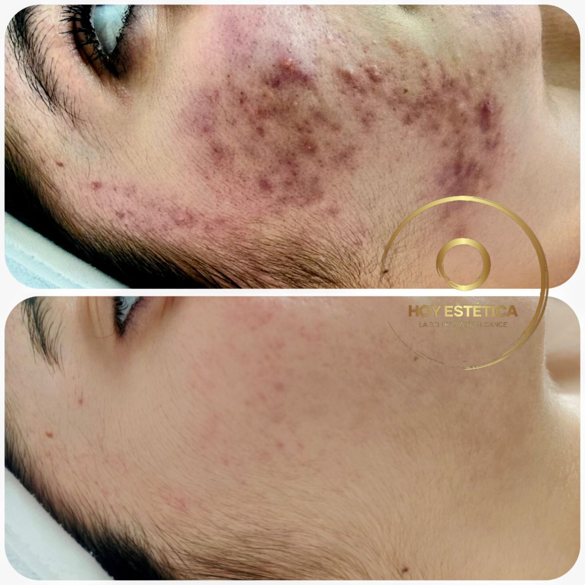 tratamiento acne pamplona